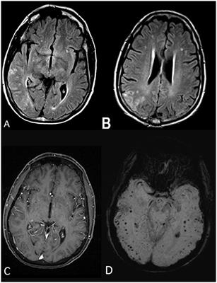 Cerebral Amyloid Angiopathy-Related Inflammation in the Immunosuppressed: A Case Report